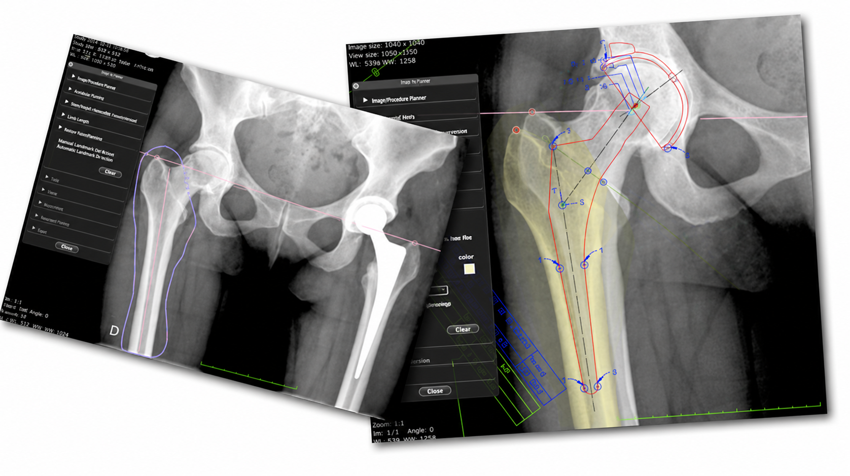 Hip radiographs with implant templates overlaid for hip arthroplasty planning.